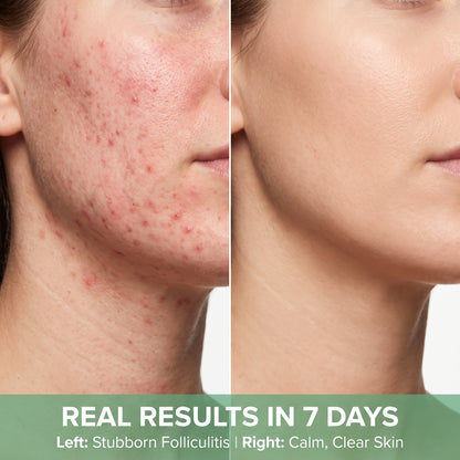 Frustrated by Stubborn Skin Rashes, Folliculitis, or Irritation That Over-the-Counter Creams Just Won’t Touch? Clear skin in as little as 7 days